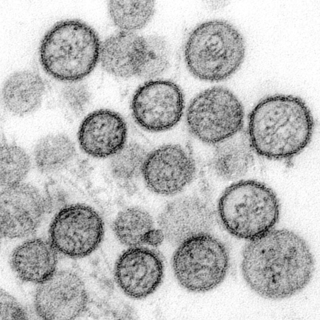 WHO reports another Netherlands hantavirus case tied to the MV Hondius outbreak
